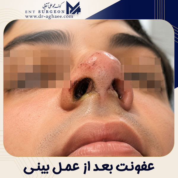 عفونت بینی بعد از عمل + دکتر محمدعلی آقایی